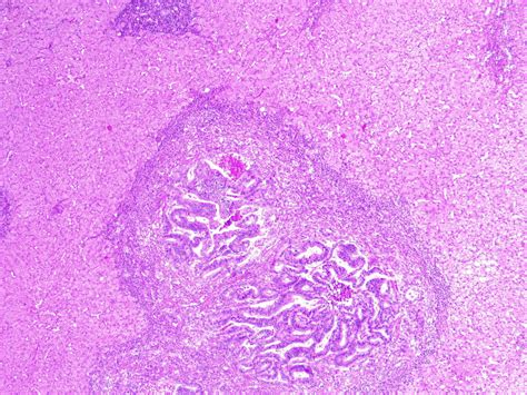 [figure Liver Metastasis In Colorectal Cancer This ] Statpearls