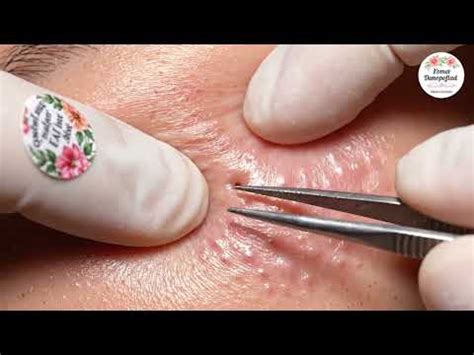 🤯 Blackheads BEGONE! AMAZING Removal Trick #28 You NEED To See! 👃 - YouTube