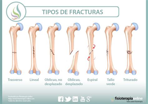 Neumon A Pol Tico Collar Las Fracturas Pueden Ser Brillante Invitaci N