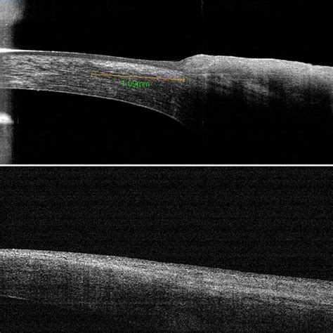 Preoperative A And Postoperative B Fd Oct Showing Scar As