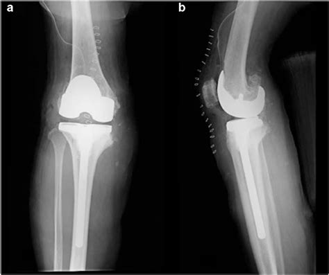 Postoperative Radiograph A Anteroposterior View B Lateral View Download Scientific Diagram