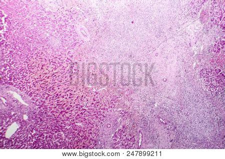 Histopathology Liver Image Photo Free Trial Bigstock