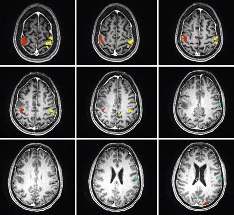 Understanding The Significance Of Increased Functional Magnetic