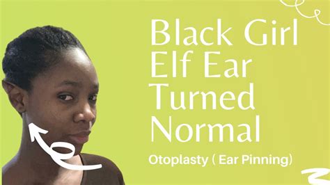 Black Girl Elf Ear Turned Normal Otoplasty Ear Pinning Series Youtube