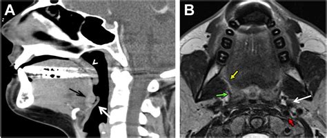 anatomy  imaging   nasopharynx oropharynx  oral cavity
