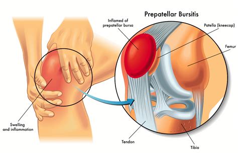 Prepatellar Knee Bursitis Orchard Health Clinic Osteopathy