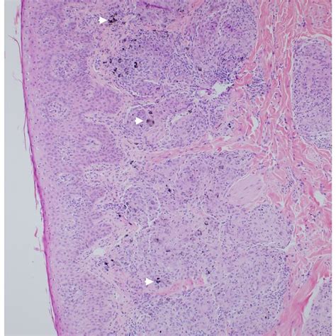 A Photomicrograph Of A Punch Biopsy Obtained From The Papule Showing