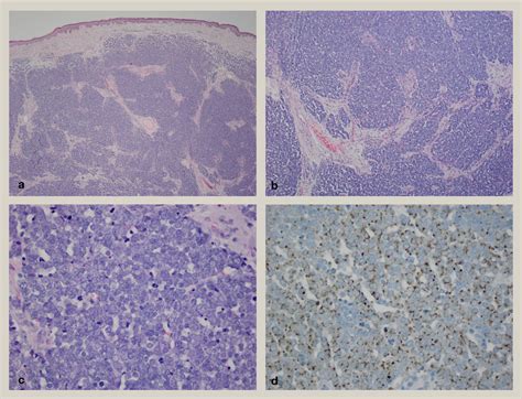 Merkel Cell Carcinoma Pathology / Merkel Cell Carcinoma And Metastatic And Sarcomatoid ...