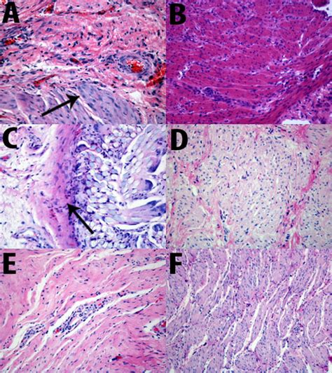 Comparison Of Novel Tissue Apposing Device And Standard Anastomotic