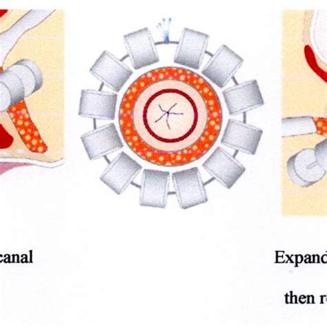 Magnetic Anal Sphincter Augmentation Device Closed Left And Open