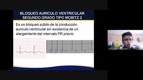 Bloqueo Auriculo Ventricular Segundo Grado Tipo Mobitz 2 Patologia EKG