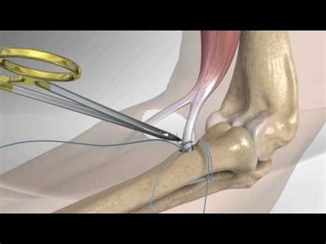 Distal Biceps Repair With Arthrex Tension Slide YouTube