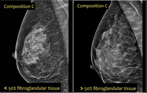 The Radiology Assistant Bi Rads For Mammography And Ultrasound