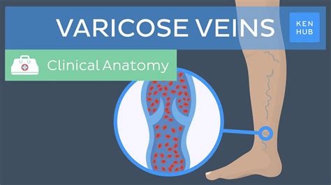 Varicose Veins Definition Causes Symptoms And Treatment Kenhub