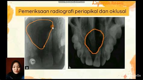 Journal Reading Dental Radiology Kista Duktus Nasopalatina Elvina