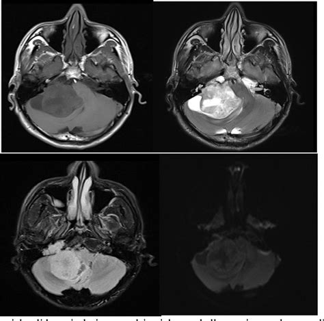 Figure 1 from Role of MRI in Evaluation of Posterior Fossa Tumours ...