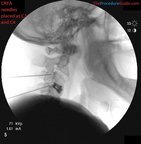 Hypogastric Plexus Block - Technique and Overview - The Procedure Guide