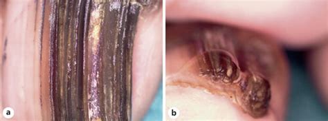 A Dorsal Plate Onychoscopy Showing Longitudinal Parallel White Gray Download Scientific