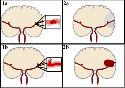 stroke wikipedia