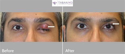 Eyelid Chalazion Surgery Before And After Gallery Taban Md