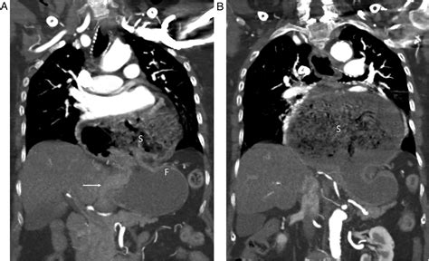 Epigastric Pain A Life Threatening Condition Emergency Medicine Journal