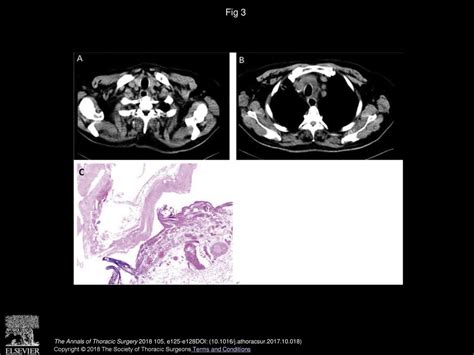 Urgent Surgical Approach To Mediastinal Cyst Causing Life Threatening