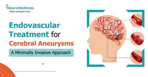 Endovascular Treatment for Cerebral Aneurysms: A Guide