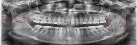 Mandibular Morphometric Analysis For Sex Assessment A Retro