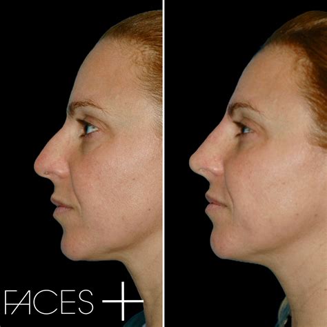 Non Surgical Nose Job Face Surgery Face Nose Job