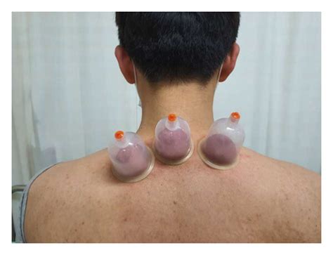 Cupping Therapy For Migraine A Prisma‐compliant Systematic Review And Meta‐analysis Of