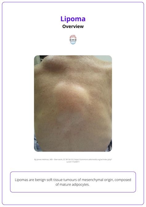 Lipoma: Aetiology, Clinical Presentation, & Management