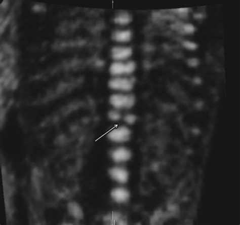 Prenatal Diagnosis Of Isolated Butterfly Vertebra Youssef 2014