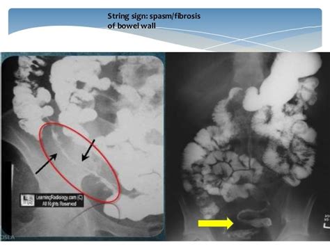 Inflammatory Bowel Disease Imagingradiology