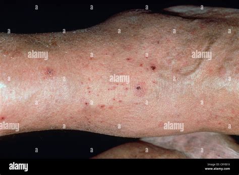 Purpura skin hi-res stock photography and images - Alamy