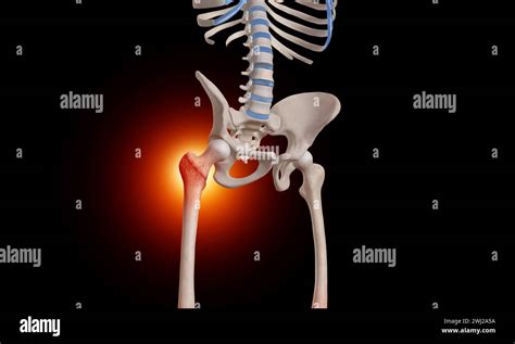 Intertrochanteric Fracture On The Femur Head Skeleton 3d Medical