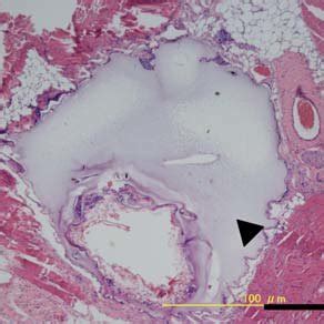 Local Tumor Histology Five Alginate Beads Containing The Osteosarcoma
