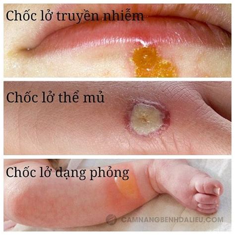 benh choc nguyen nhan bien chung va cach dieu tri