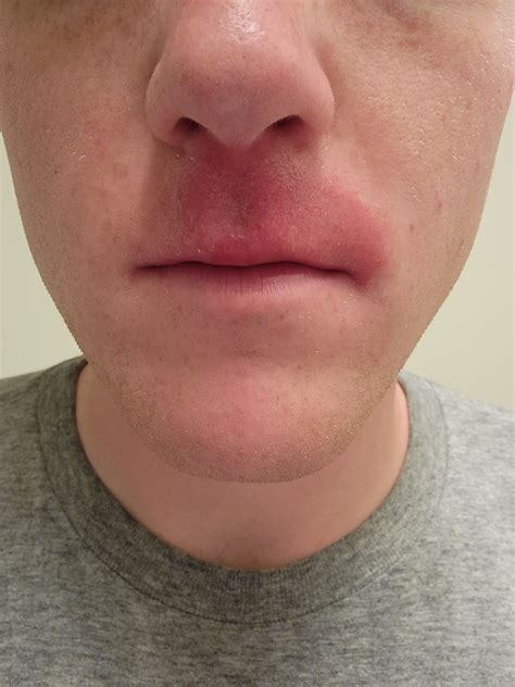 Irritated upper lip won't go away : r/DermatologyQuestions