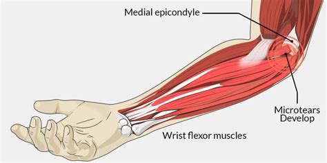 Golfers Elbow Medial Epicondylitis Motus Physical Therapy