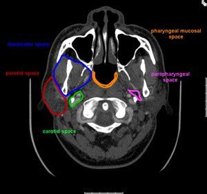 Radiologist For Ever: Parapharyngeal space rule 1:Anatomy and pathology