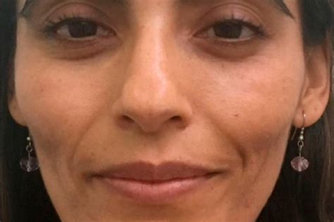 Dra Sandra Narea Especialista En Armonizaci N Orofacial Avanzada