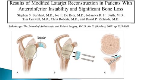 Tecnica De Latarjet Inestabilidad De Hombro Luxaci N De Hombro Ppt