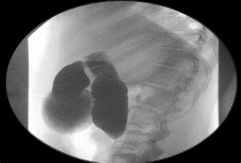 Image From Upper Gastrointestinal Fluoroscopic Series Demonstrating