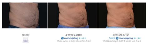 Coolsculpting Real Results In North Myrtle Beach Sc