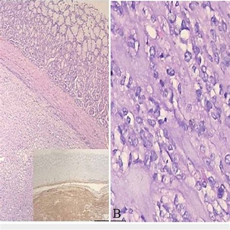 Histopathological image of the gastrointestinal stromal tumor. (A ...