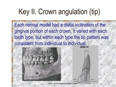 Andrews 6 Keys Of Normal Occlusion Certified Fixed Orthodontic Courses By Indian Dental Academy