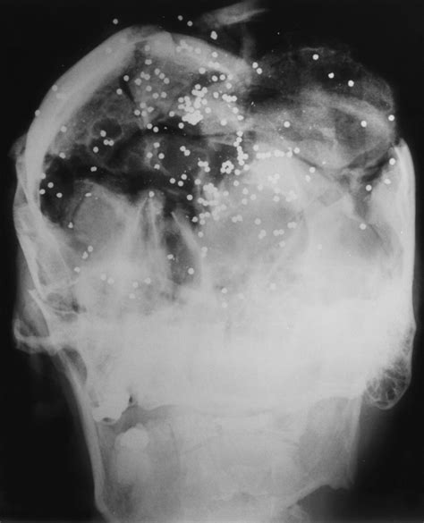 Gunshot Injuries: What Does a Radiologist Need to Know? | RadioGraphics