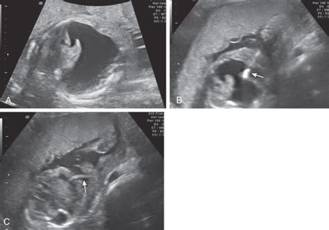 Fetal Shunts Radiology Key