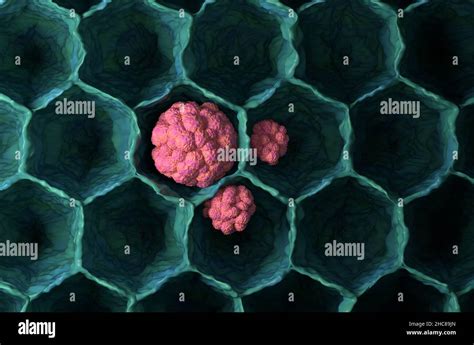 Lung Cancer Tumor Microbiology D Illustration Top View Stock Photo Alamy