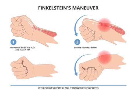 De Quervains Tenosynovitis Pivotal Motion Physiotherapy Porn Sex Picture